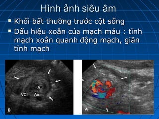 Hình ảnh siêu âmHình ảnh siêu âm
 Khối bất thường trước cột sốngKhối bất thường trước cột sống
 Dấu hiệu xoắn của mạch máu : tĩnhDấu hiệu xoắn của mạch máu : tĩnh
mạch xoắn quanh động mạch, giãnmạch xoắn quanh động mạch, giãn
tĩnh mạchtĩnh mạch
 