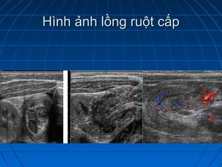 Hình ảnh lồng ruột cấpHình ảnh lồng ruột cấp
 