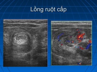 Lồng ruột cấpLồng ruột cấp
 