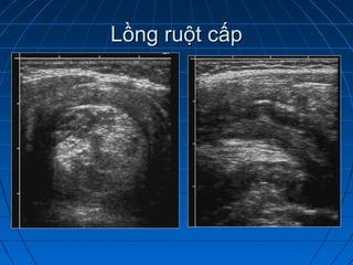 Lồng ruột cấpLồng ruột cấp
 
