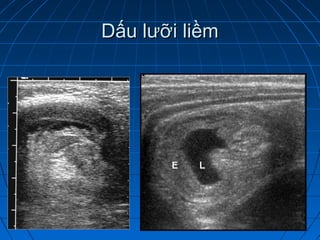 Dấu lưỡi liềmDấu lưỡi liềm
 