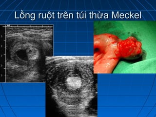 Lồng ruột trên túi thừa MeckelLồng ruột trên túi thừa Meckel
 
