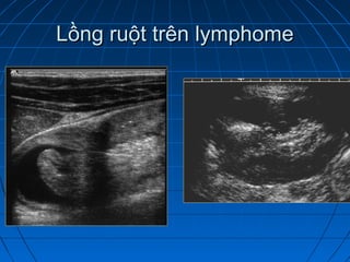 Lồng ruột trên lymphomeLồng ruột trên lymphome
 