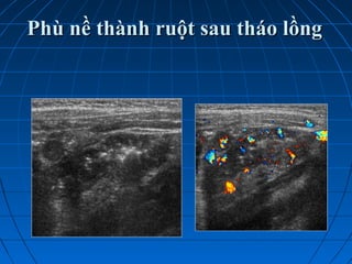 Phù nề thành ruột sau tháo lồngPhù nề thành ruột sau tháo lồng
 