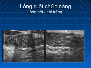 Lồng ruột chức năngLồng ruột chức năng
(lồng hồi - hồi tràng)(lồng hồi - hồi tràng)
 