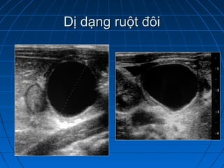 Dị dạng ruột đôiDị dạng ruột đôi
 