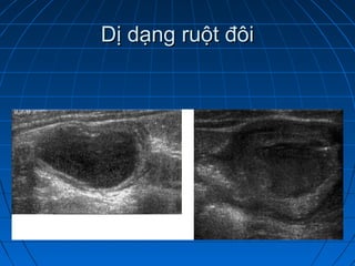 Dị dạng ruột đôiDị dạng ruột đôi
 