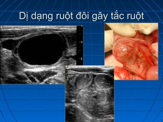 Dị dạng ruột đôi gây tắc ruộtDị dạng ruột đôi gây tắc ruột
 