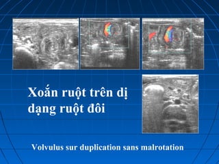 Xoắn ruột trên dị
dạng ruột đôi
Volvulus sur duplication sans malrotation
 