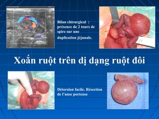 Bilan chirurgical :
présence de 2 tours de
spire sur une
duplication jéjunale.
Détorsion facile. Résection
de l’anse porteuse
Xoắn ruột trên dị dạng ruột đôi
 