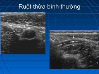 Ruột thừa bình thườngRuột thừa bình thường
 
