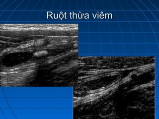 Ruột thừa viêmRuột thừa viêm
 