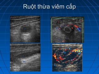 Ruột thừa viêm cấpRuột thừa viêm cấp
 