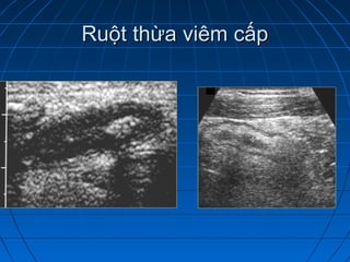 Ruột thừa viêm cấpRuột thừa viêm cấp
 