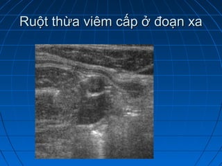 Ruột thừa viêm cấp ở đoạn xaRuột thừa viêm cấp ở đoạn xa
 
