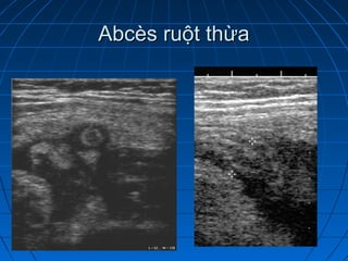 Abcès ruột thừaAbcès ruột thừa
 