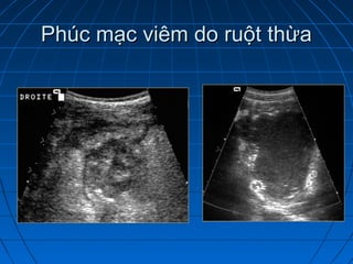Phúc mạc viêm do ruột thừaPhúc mạc viêm do ruột thừa
 