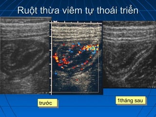 Ruột thừa viêm tự thoái triểnRuột thừa viêm tự thoái triển
trướctrước 1tháng sau1tháng sau
 