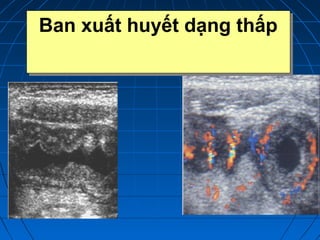 Ban xuất huyết dạng thấpBan xuất huyết dạng thấp
 