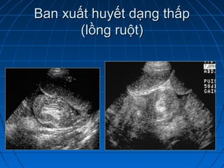 Ban xuất huyết dạng thấpBan xuất huyết dạng thấp
(lồng ruột)(lồng ruột)
 
