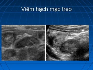 Viêm hạch mạc treoViêm hạch mạc treo
 