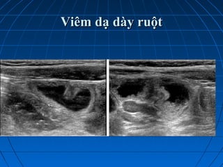 Viêm dạ dày ruộtViêm dạ dày ruột
 