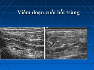 Viêm đoạn cuối hồi tràngViêm đoạn cuối hồi tràng
 