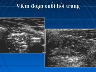Viêm đoạn cuối hồi tràngViêm đoạn cuối hồi tràng
 