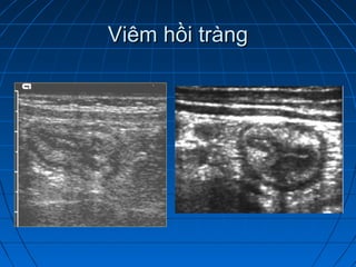 Viêm hồi tràngViêm hồi tràng
 