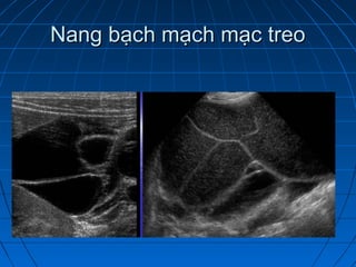 Nang bạch mạch mạc treoNang bạch mạch mạc treo
 