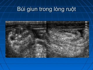 Búi giun trong lòng ruộtBúi giun trong lòng ruột
 