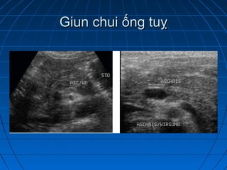 Giun chui ống tuỵGiun chui ống tuỵ
 