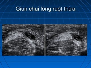 Giun chui lòng ruột thừaGiun chui lòng ruột thừa
 