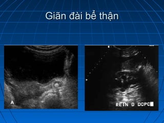 Giãn đài bể thậnGiãn đài bể thận
 