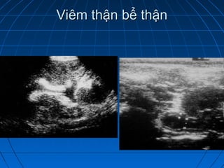 Viêm thận bể thậnViêm thận bể thận
 