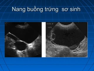Nang buồng trứng sơ sinhNang buồng trứng sơ sinh
 