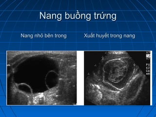 Nang buồng trứngNang buồng trứng
Nang nhỏ bên trong Xuất huyết trong nangNang nhỏ bên trong Xuất huyết trong nang
 