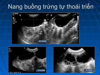 Nang buồng trứng tự thoái triểnNang buồng trứng tự thoái triển
 