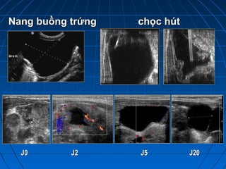 Nang buồng trứngNang buồng trứng chọc hútchọc hút
J0J0 J2J2 J5J5 J20J20
 