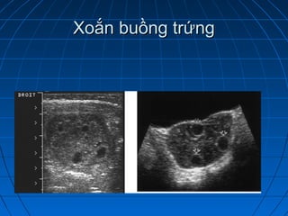 Xoắn buồng trứngXoắn buồng trứng
 