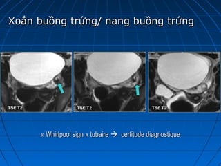 Xoắn buồng trứng/ nang buồng trứngXoắn buồng trứng/ nang buồng trứng
« Whirlpool sign » tubaire « Whirlpool sign » tubaire   certitude diagnostique  certitude diagnostique
TSE T2 TSE T2TSE T2
 