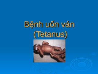 B
Bệnh uốn ván
ệnh uốn ván
(Tetanus)
(Tetanus)
 