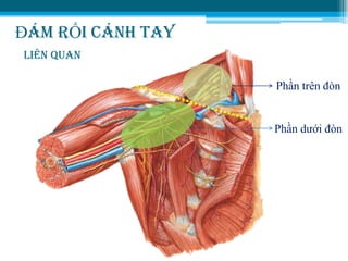 ĐÁM RỐI CÁNH TAY
LIÊN QUAN
Phần trên đòn
Phần dƣới đòn
 