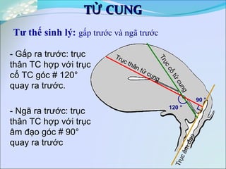 T CUNGỬT CUNGỬ
Tư thế sinh lý: gấp trước và ngã trước
- Gấp ra trước: trục
thân TC hợp với trục
cổ TC góc # 120°
quay ra trước.
- Ngã ra trước: trục
thân TC hợp với trục
âm đạo góc # 90°
quay ra trước
120 °
90 °
 