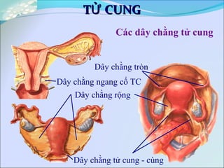 T CUNGỬT CUNGỬ
Các dây chằng tử cung
Dây chằng tròn
Dây chằng ngang cổ TC
Dây chằng rộng
Dây chằng tử cung - cùng
 