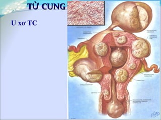 20
T CUNGỬT CUNGỬ
U xơ TC
 