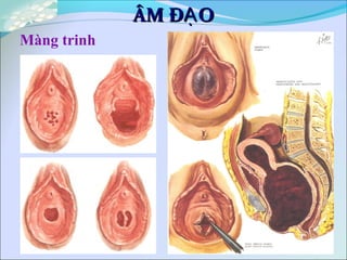 Màng trinh
ÂM Đ OẠÂM Đ OẠ
 