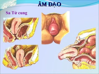 Sa Tử cung
ÂM Đ OẠÂM Đ OẠ
 