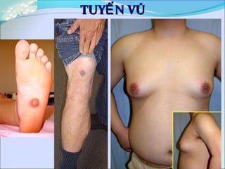 TUY N VÚẾTUY N VÚẾ
 