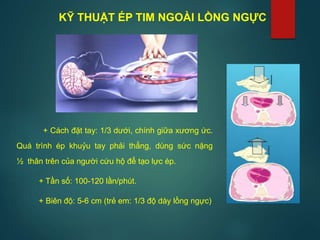KỸ THUẬT ÉP TIM NGOÀI LỒNG NGỰC
+ Cách đặt tay: 1/3 dưới, chính giữa xương ức.
Quá trình ép khuỷu tay phải thẳng, dùng sức nặng
½ thân trên của người cứu hộ để tạo lực ép.
+ Tần số: 100-120 lần/phút.
+ Biên độ: 5-6 cm (trẻ em: 1/3 độ dày lồng ngực)
 